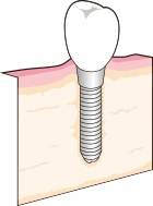 インプラントのイラスト